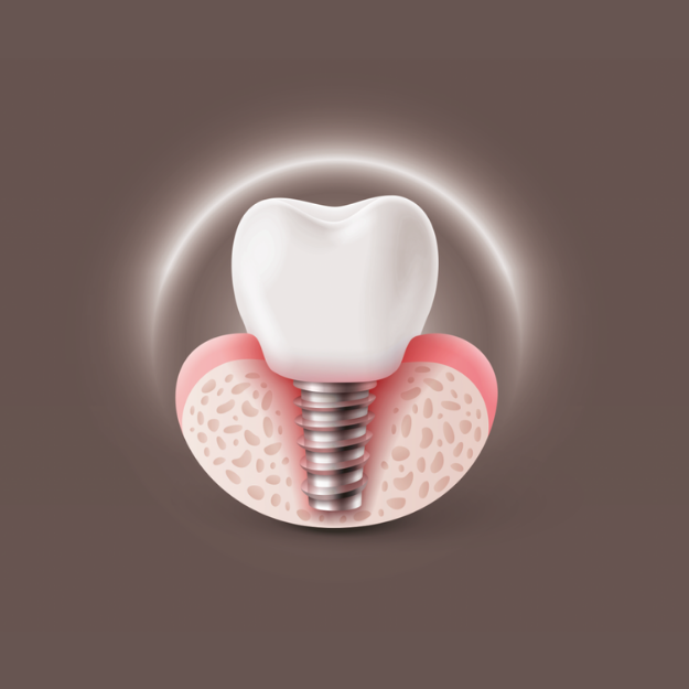 Dental Implant